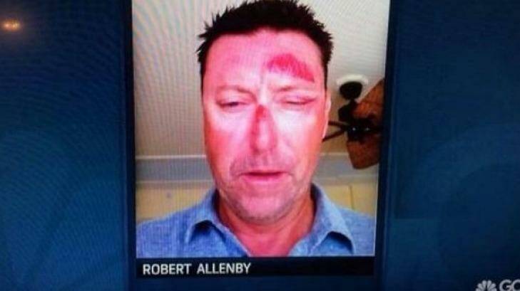 Robert Allenby posted an image of his battered face on Twitter. Photo: Twitter account @aussieallenby